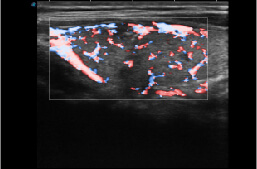 SR-Flow Ultrasound