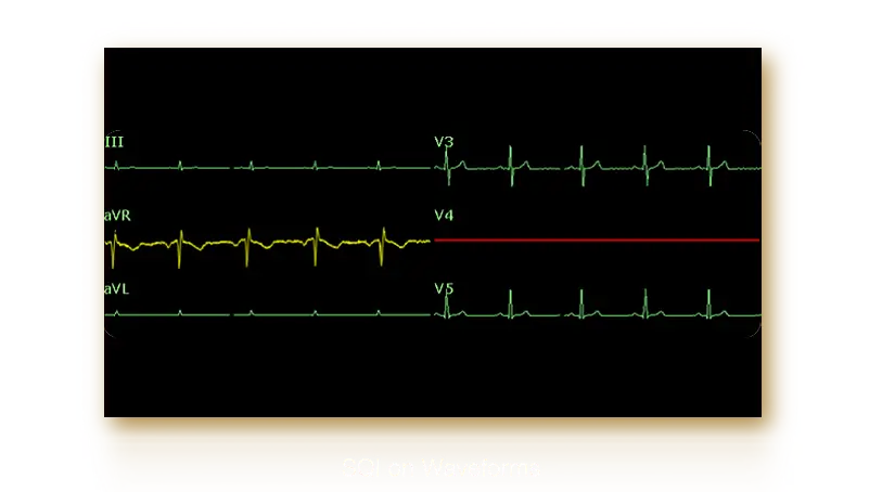 PC-ECG-SE-1515_11