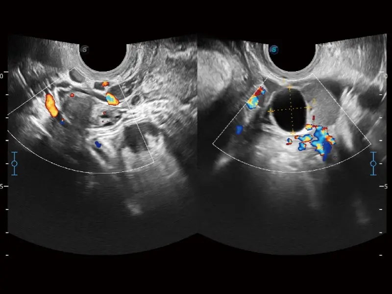 Bilateral Ovaries