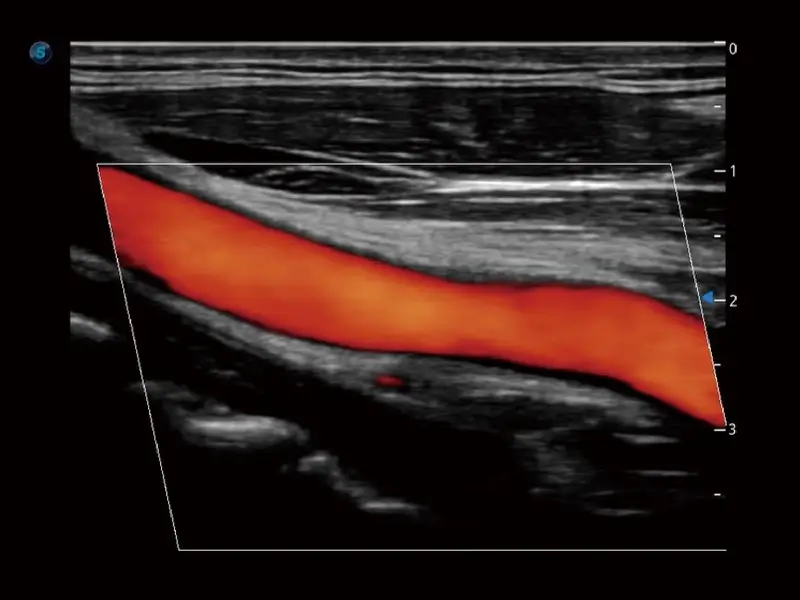 Carotid Artery