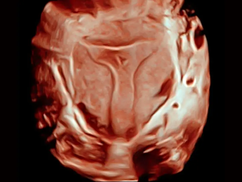 Intrauterine Adhesion